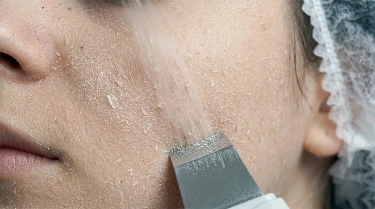 Skinscraper treatment Almere – Schoonheidsstudio Almere